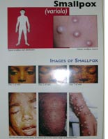 Smallpox is ugly