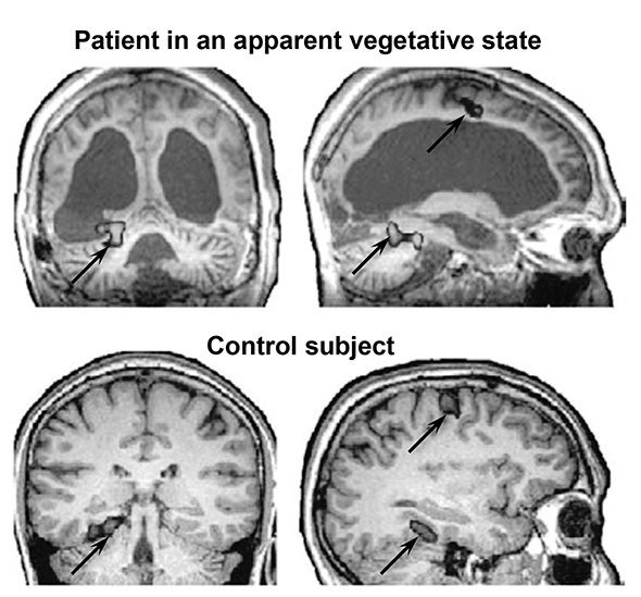 Damage brain ambien cure