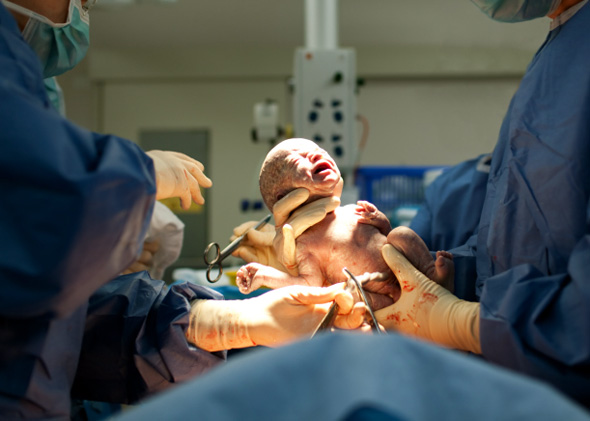 130906_TWO_BirthHospital Baby being born via Caesarean Section.