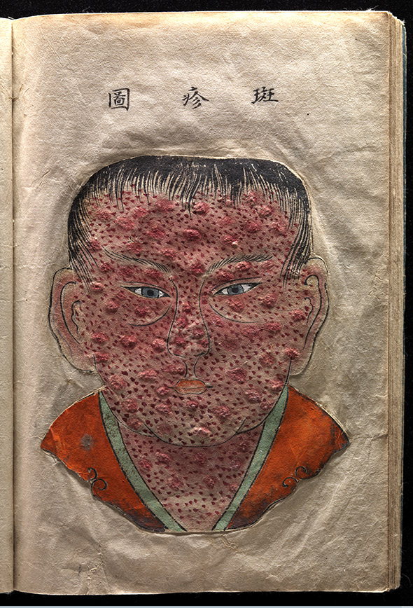 Smallpox, textured illustration, Japanese manuscript.