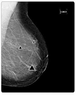 The R2 ImageChecker CAD pinpoints areas of concern on a mammogram.