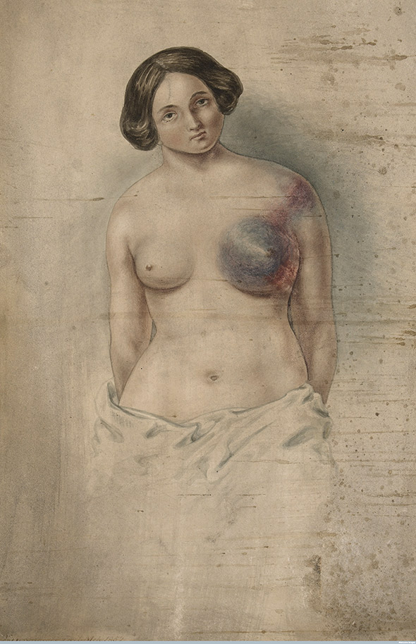 Woman suffering from cancer of the left breast. Watercolor by John Guise Westmacott, 1852. 