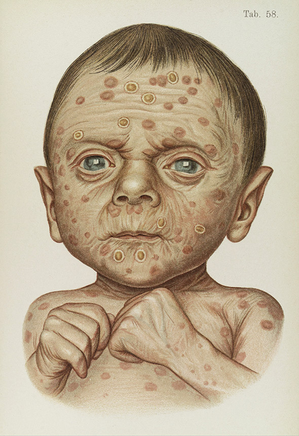 Illustration of baby diseased with hereditary syphilis.