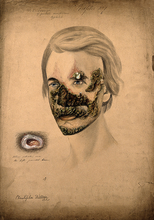 Syphilis sufferer with severe pustule crustaceous lesions. Pencil, white chalk, and watercolor drawing by Christopher D'Alton, 1855. 