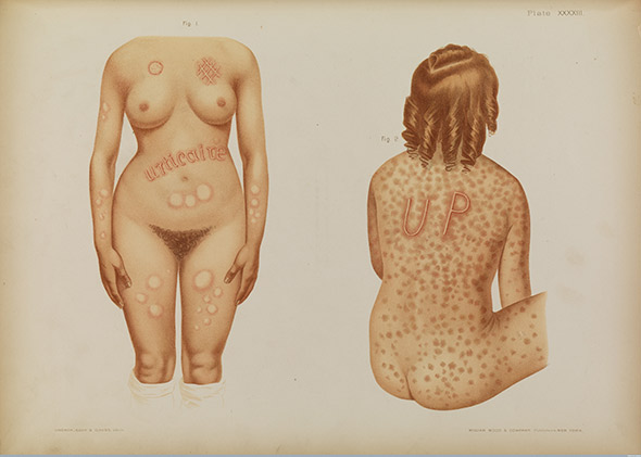 Patient treated for the skin disease urticaria. Plate by Prince A. Morrow, in the Atlas of Skin and Venereal Diseases, 1889. 